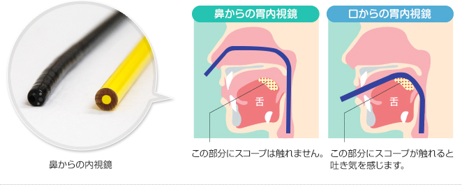 鼻からの胃カメラ（経鼻内視鏡検査）