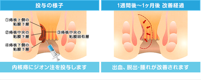 ジオン硬化療法